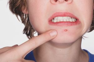  Cum să scapi de acnee subcutanată pe bărbie