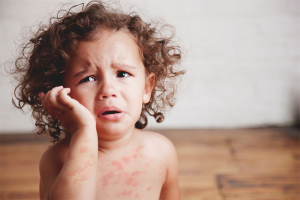  Cómo tratar las colmenas en los niños.