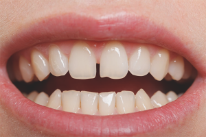  Kaip pašalinti tarpą tarp priekinių dantų