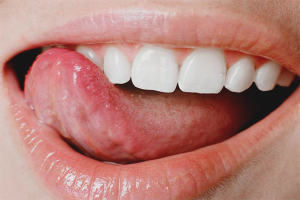  Com desfer-se de l'acne a la llengua