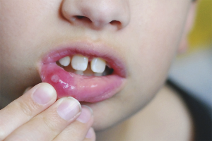  Cómo tratar la estomatitis en un niño