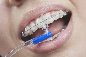  Bagaimana untuk memberus gigi dengan penyokong gigi