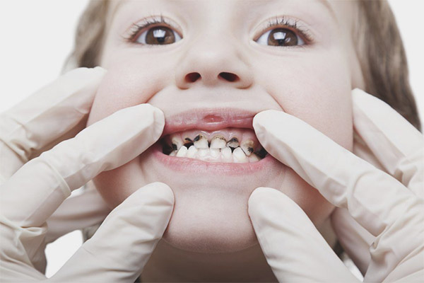 Plaque Noire Sur Les Dents D Un Enfant Causes Et Traitement