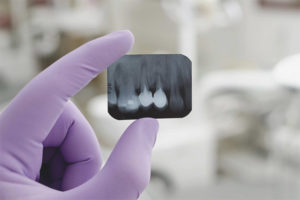  Възможно ли е рентгенови зъби по време на бременност?