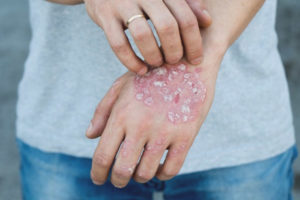  Cómo tratar la psoriasis