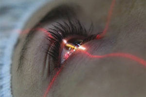  Corectarea vederii laserului