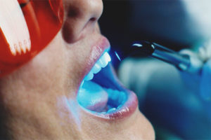  Pemutihan gigi laser