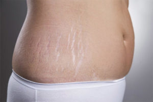  Is it possible to remove stretch marks after childbirth
